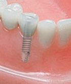 implant dentar